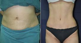 Abdominoplasty