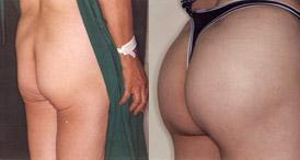 Buttocks Enhancement