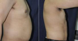 Liposuction