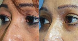 Blepharoplasty