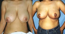 Breast Reduction