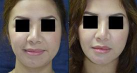 Chin Augmentation