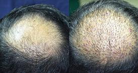 Hair Transplant