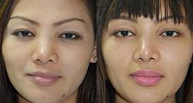 Rhinoplasty