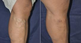 Sclerotherapy