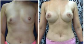 Breast Augmentation