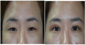 Eyelid Fold Creation