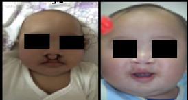 Cleft Lip/Palate Surgery